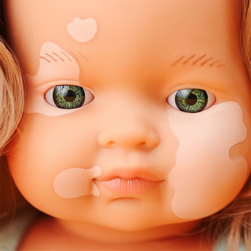 Miniland Girl Doll With Vitiligo Mulberry - 38cm